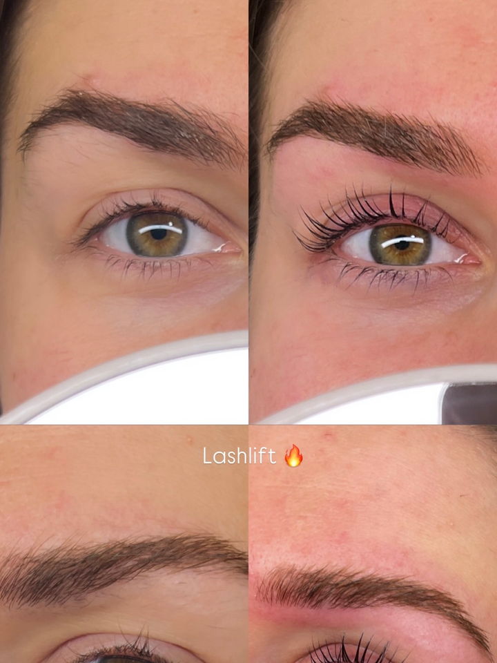 Vorher-Nachher Browlift – präzise Bogenkorrektur